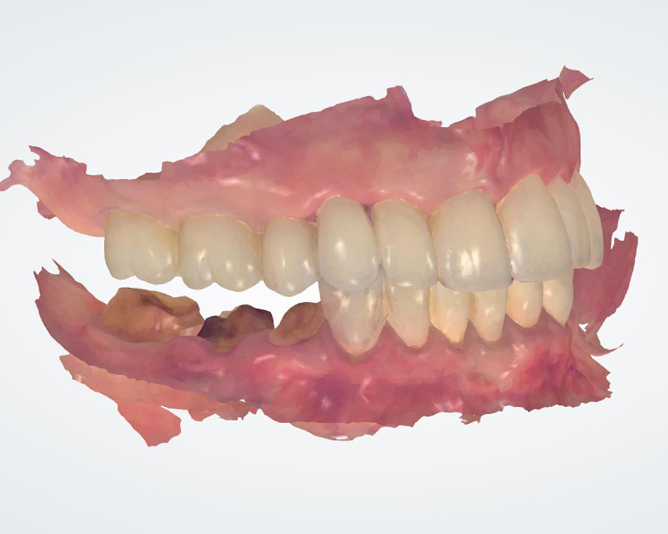 LCIAD 3-Shape intraoral scan