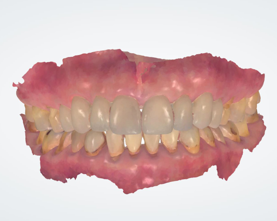 LCIAD 3-Shape intra oral scan upper and lower