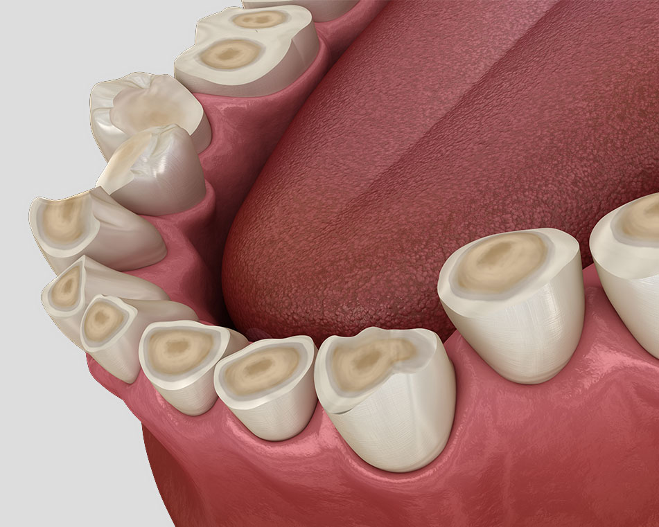 LCIAD Dental tooth wear attrition brxism tooth surface loss