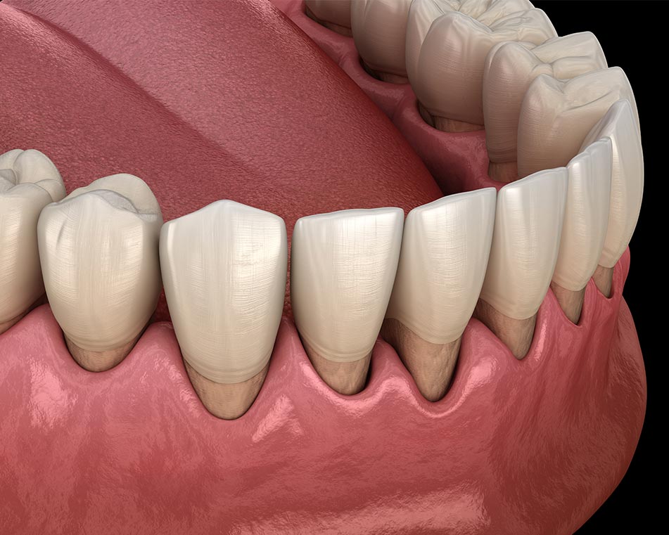 LCIAD gum recession