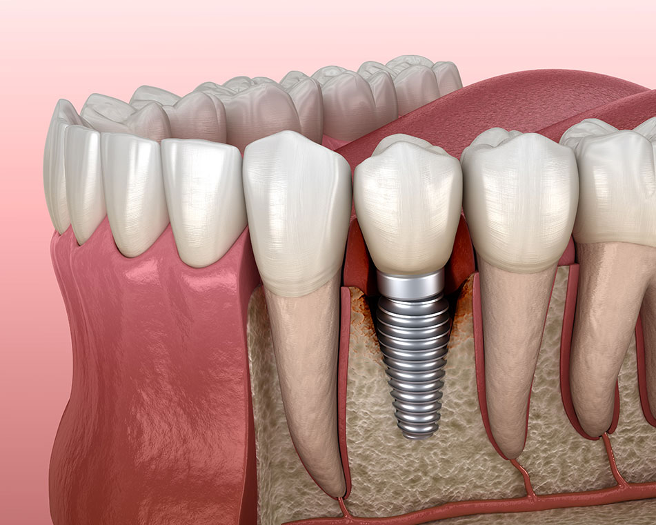 LCIAD Peri-implantitis infection around dental implant