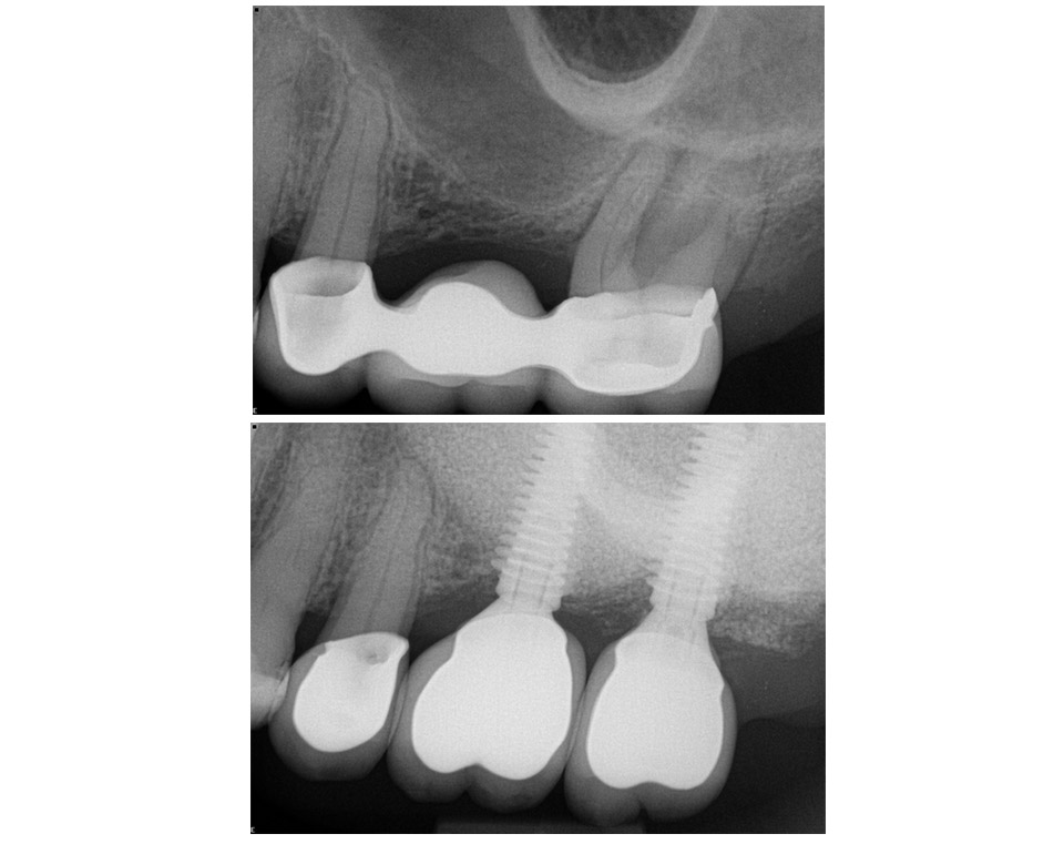 LCIAD Sinus augmentation and implants pre-op and post-op