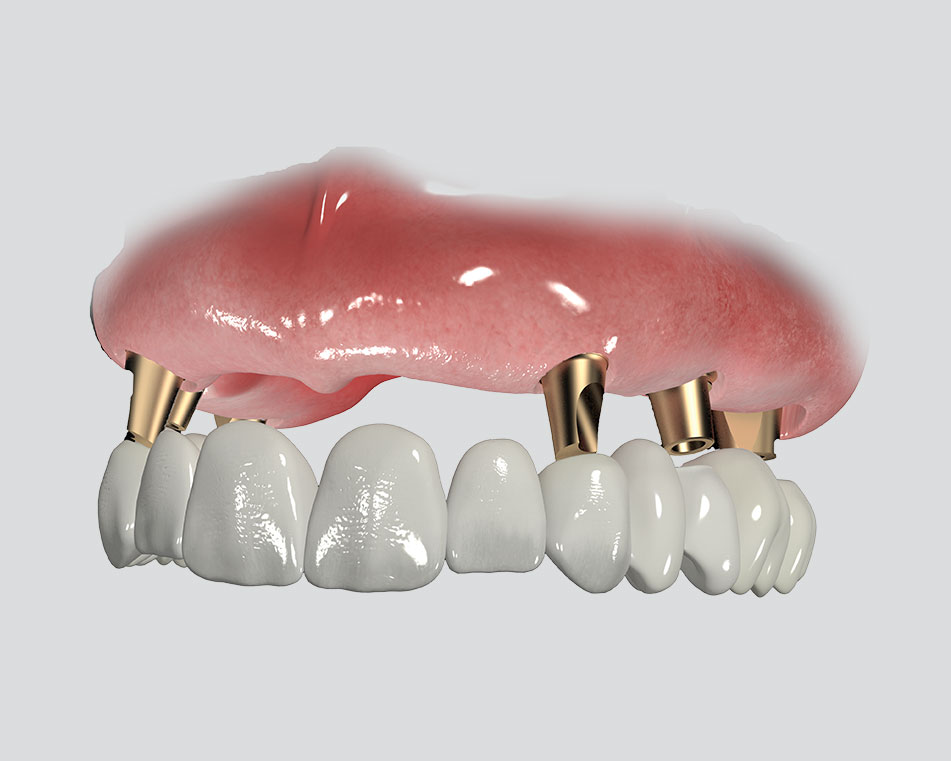 LCIAD Full aupper arch implant bridge