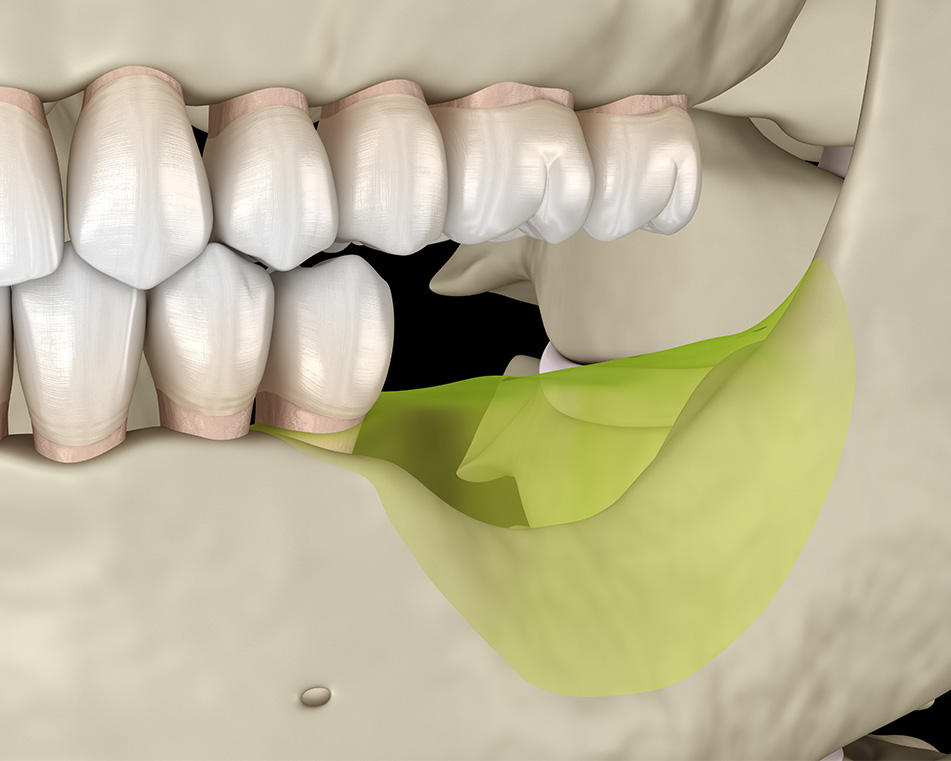 LCIAD bone volume loss posterior mandible