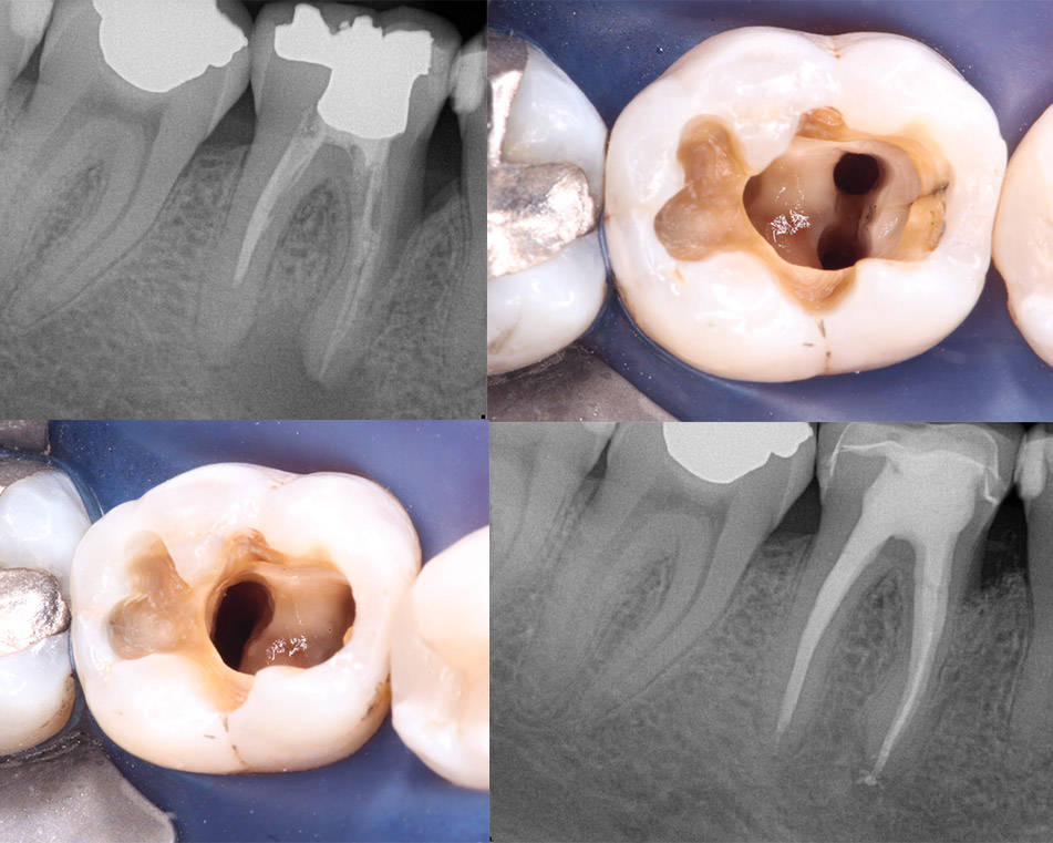 Dental restoration and rehabilitation of tooth decay and tooth erosion.