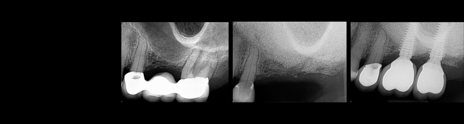 Sinus grafting