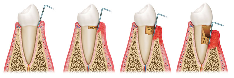 LCIAD gum disease periodontal disease gingivitis
